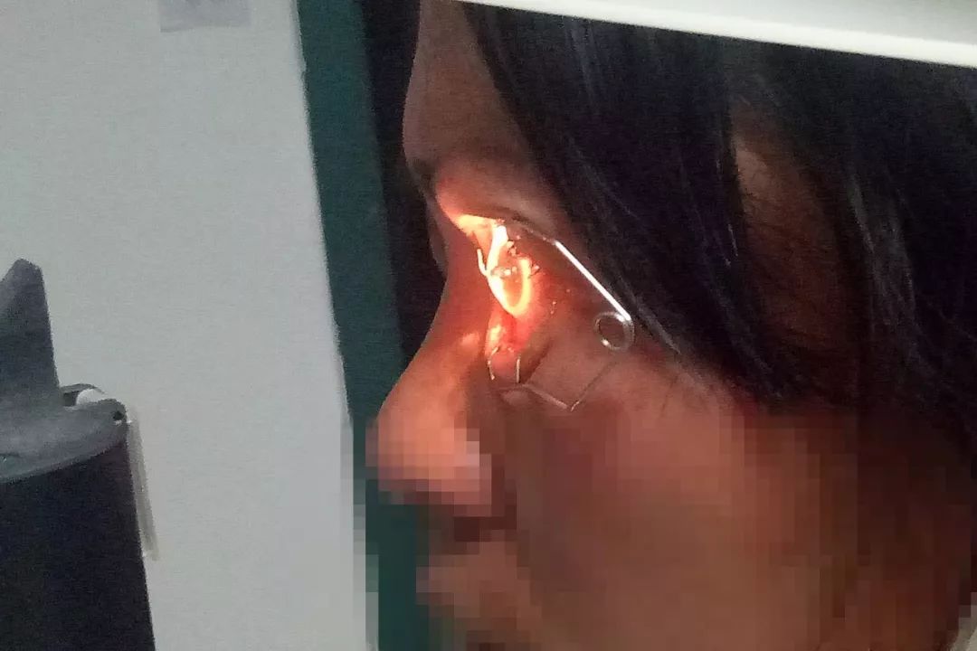 37岁女工眼球穿通伤，专家：越早就医越好