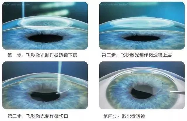 @近视党，这周天近视手术交流会邀你参加